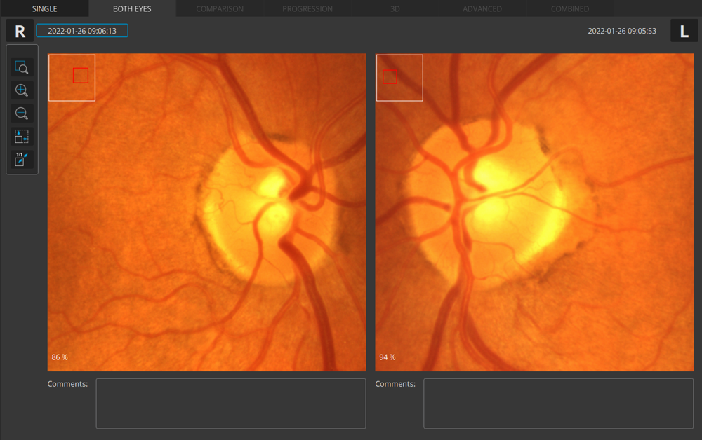 Affichage de la photo du fond d'œil en plein écran des 2 yeux